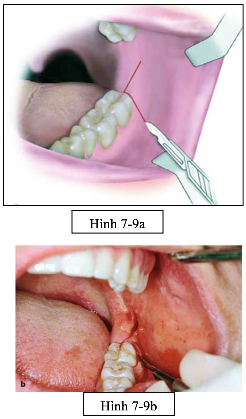 Phẫu thuật lấy mầm răng